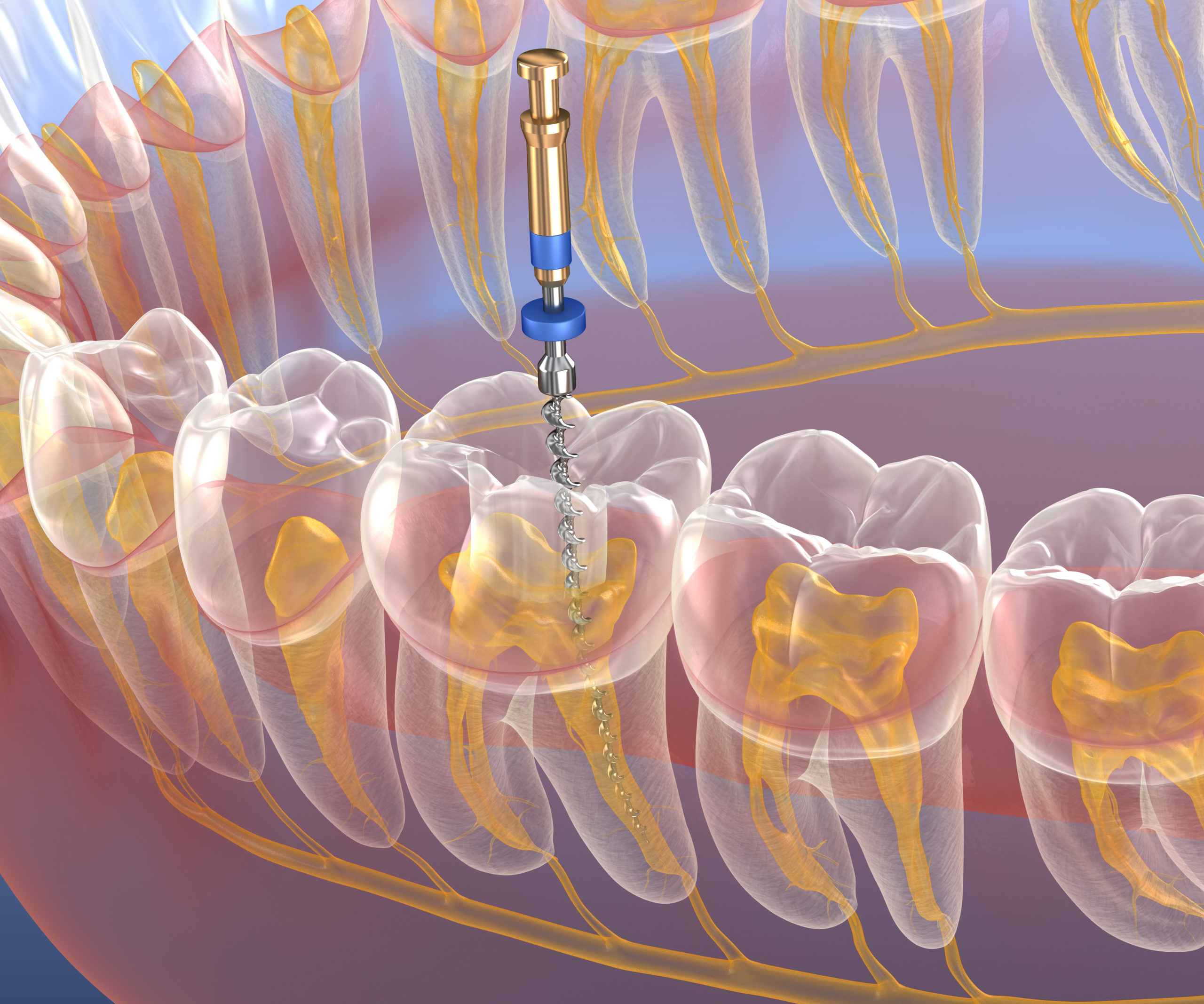 Endodontic Root Canal Treatment Process Medically Accurate Tooth D Illustration Lvi Global